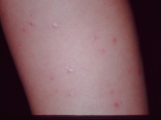 紅色汗疹と膿疱性汗疹・湿疹性汗疹